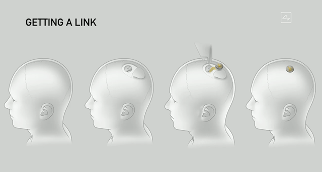 重磅！马斯克旗下脑机接口公司Neuralink官宣：首次人体临床试验获FDA批准，目标是人的大脑