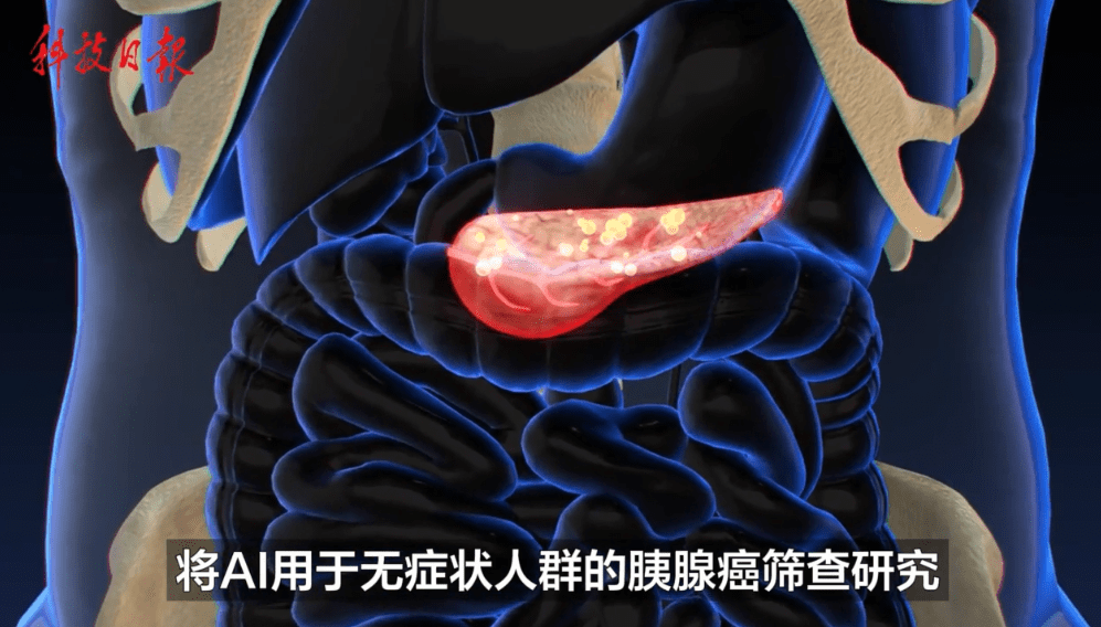 科技新突破！AI加持CT，人类首次拥有大规模筛查早期胰腺癌手段