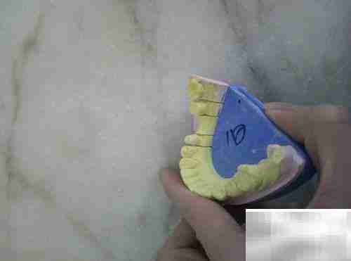 固定义齿与活动义齿对比