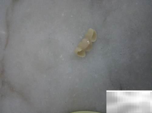 固定义齿与活动义齿怎么选