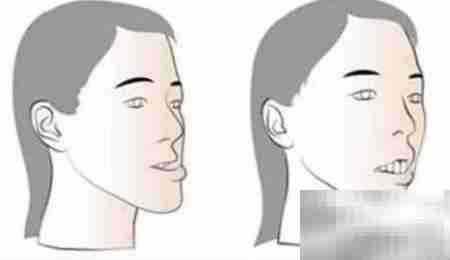 鼻基底恢复自然小技巧