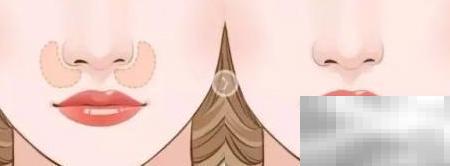 鼻基底恢复自然的技巧分享