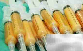 自体脂肪填充致脸歪？