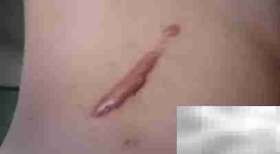 腹腔镜术后伤口愈合方法