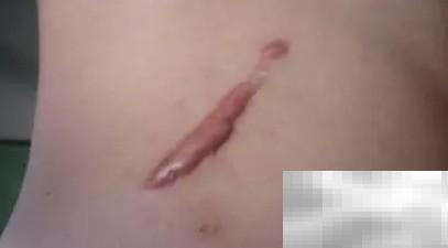 腹腔镜术后伤口护理方法